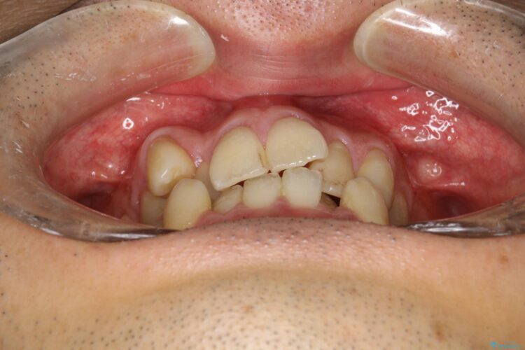 前歯のガタガタと八重歯 骨格性下顎前突のカモフラージュ矯正 治療前画像
