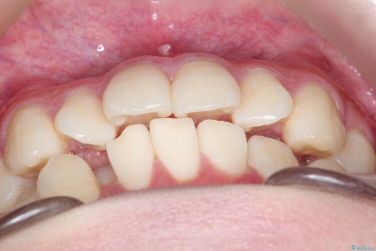 インビザラインで前歯の捻れとガタつきの改善(非抜歯) 治療前画像