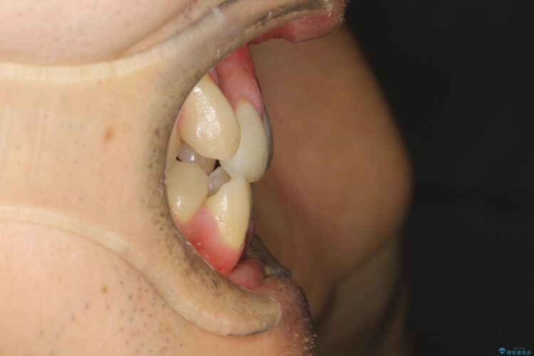 前歯のガタガタと八重歯 骨格性下顎前突のカモフラージュ矯正 治療前画像