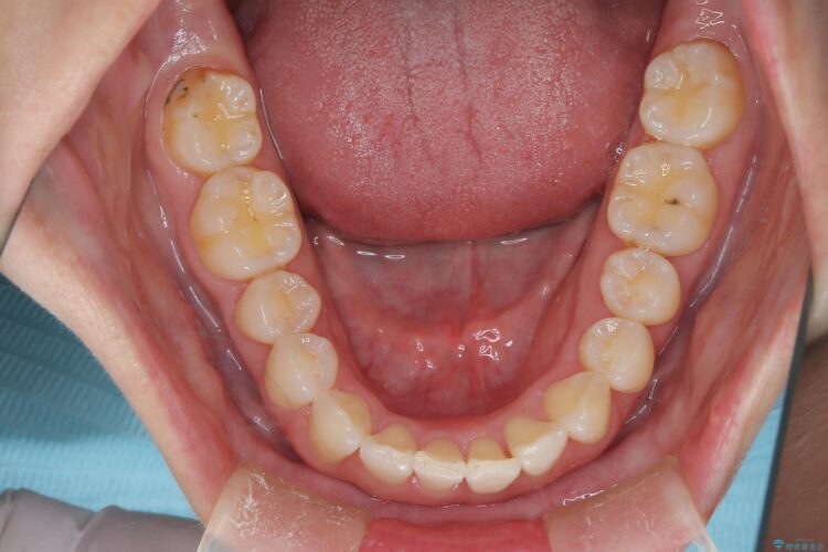インビザライン ライトパッケージで部分矯正　下の前歯のみの歯並び改善 アフター