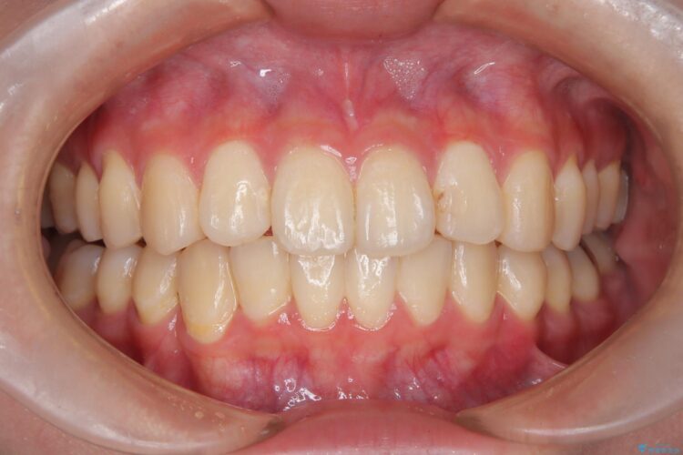 インビザラインで前歯の捻れとガタつきの改善(非抜歯) アフター
