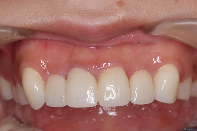 セラミック矯正で前歯をきれいに 治療後画像