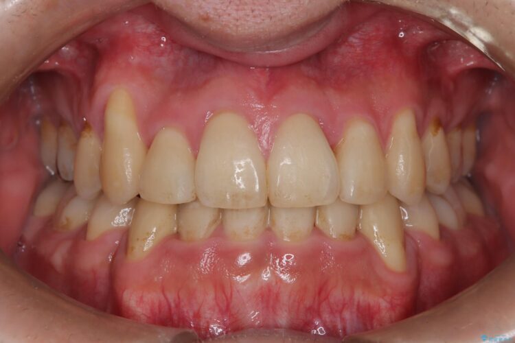 前歯のガタガタと八重歯 骨格性下顎前突のカモフラージュ矯正 アフター