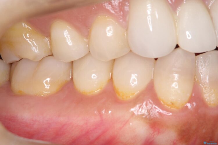 下がってしまった歯肉　バイオマテリアルを応用した歯茎の回復 アフター