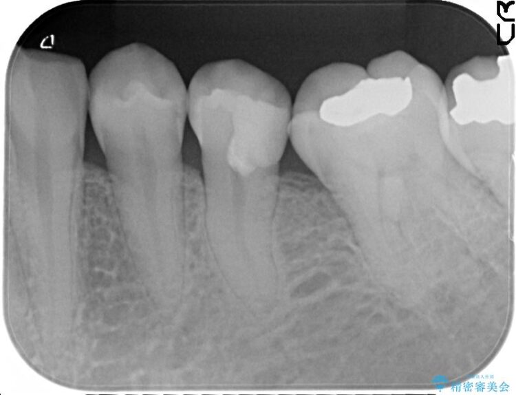 虫歯が深くなった状態で神経を残す生活歯髄療法 治療後画像