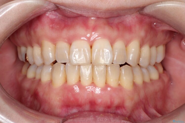 インビザラインで上下前歯の開き(開咬)と上下ガタつき(叢生)の改善 アフター