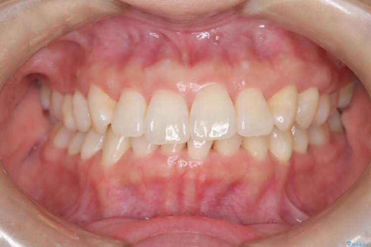インビザライン ライトパッケージで部分矯正　下の前歯のみの歯並び改善 治療後画像