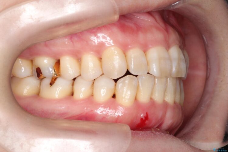 インビザラインで上下前歯の開き(開咬)と上下ガタつき(叢生)の改善 治療後画像