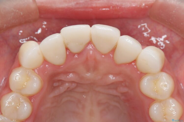 セラミック矯正で前歯をきれいに 治療後画像