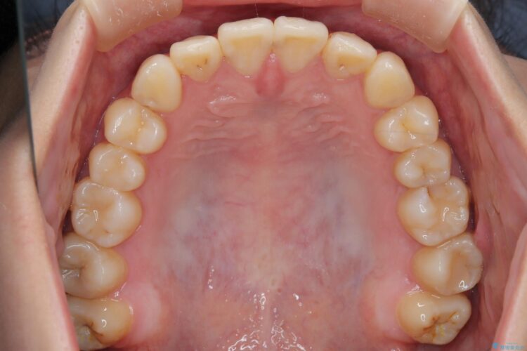 インビザラインで前歯の捻れとガタつきの改善(非抜歯) 治療後画像