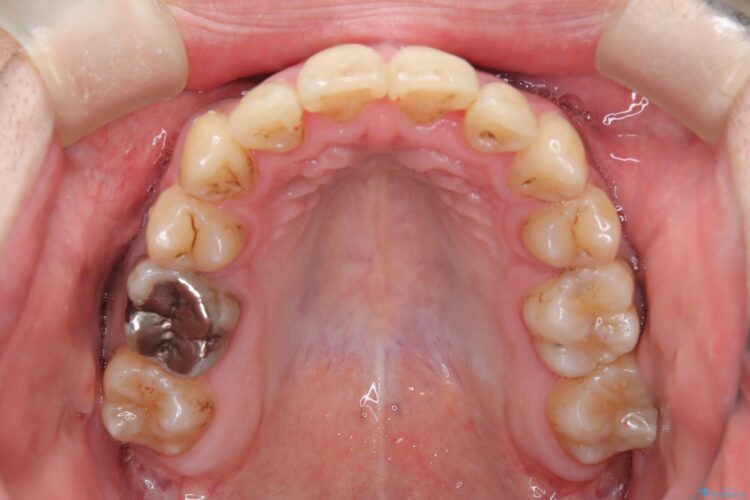 前歯のガタガタと八重歯 骨格性下顎前突のカモフラージュ矯正 治療後画像