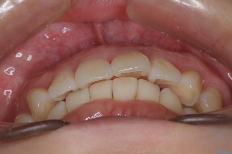 インビザライン ライトパッケージで部分矯正　下の前歯のみの歯並び改善 治療後画像