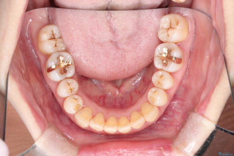 インビザラインで上下前歯の開き(開咬)と上下ガタつき(叢生)の改善 治療後画像