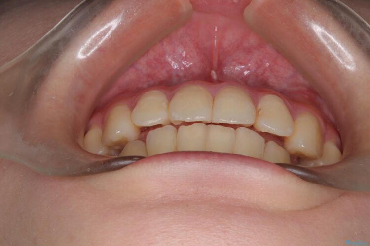 インビザラインで前歯の捻れとガタつきの改善(非抜歯) 治療後画像