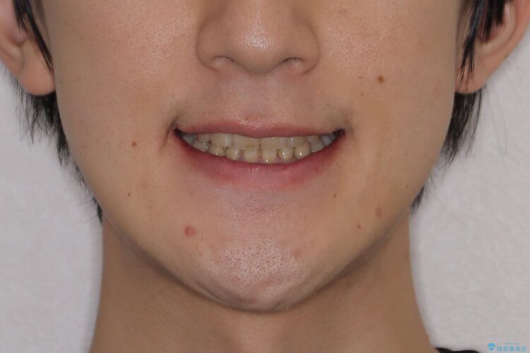 前歯のガタガタと八重歯 骨格性下顎前突のカモフラージュ矯正 治療後画像
