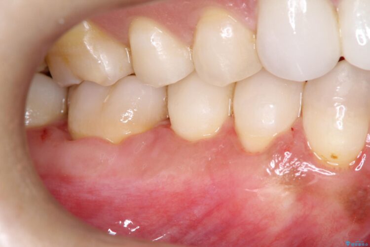 下がってしまった歯肉　バイオマテリアルを応用した歯茎の回復 治療後画像