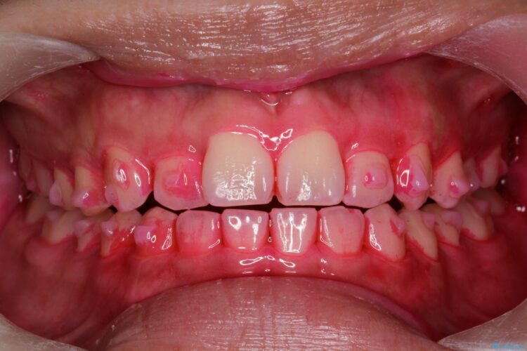インビザライン治療中の歯のクリーニング ビフォー