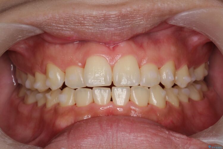 インビザライン治療中の歯のクリーニング 治療後画像