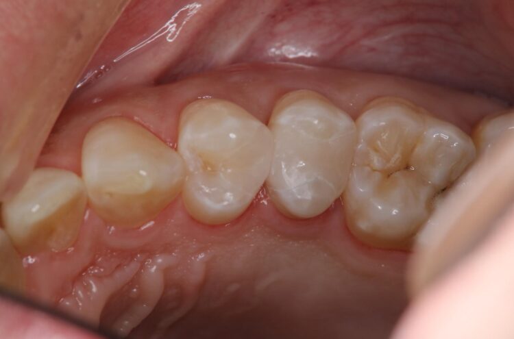 無症状の虫歯をランクの高いセラミックインレーで補綴治療 アフター