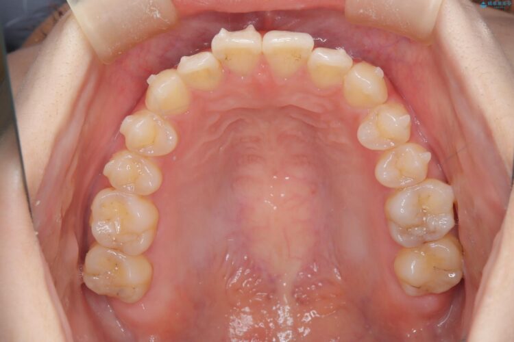 前歯の叢生と交叉咬合(クロスバイト)、後戻りをインビザラインで再矯正 治療途中画像