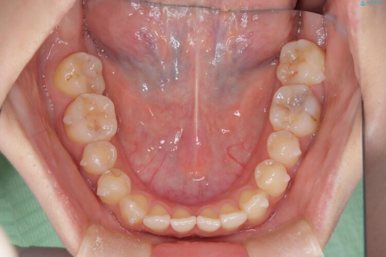 前歯の叢生と交叉咬合(クロスバイト)、後戻りをインビザラインで再矯正 治療途中画像