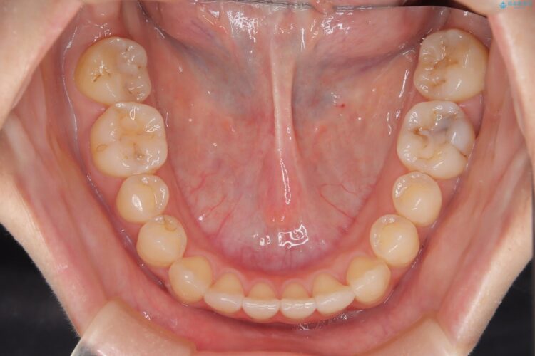 前歯の叢生と交叉咬合(クロスバイト)、後戻りをインビザラインで再矯正 治療後画像