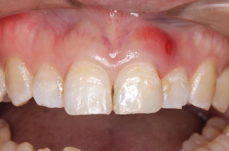 欠けた前歯をセラミッククラウンで補綴治療 治療途中画像