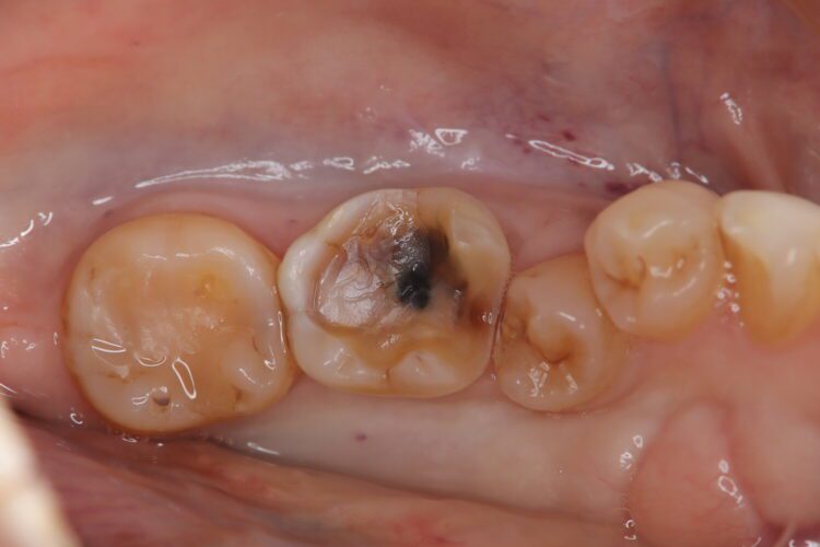 詰め物が外れてしまった歯を1Dayセラミック治療 治療途中画像