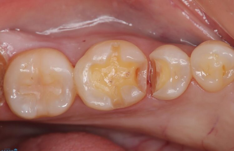 虫歯を即日セラミック治療 治療途中画像