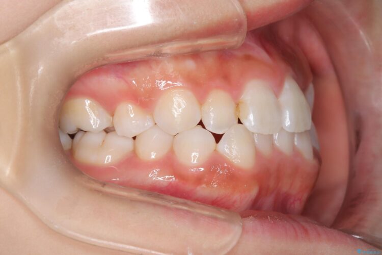 後戻りした交叉咬合（クロスバイト） マウスピースで再矯正 治療途中画像