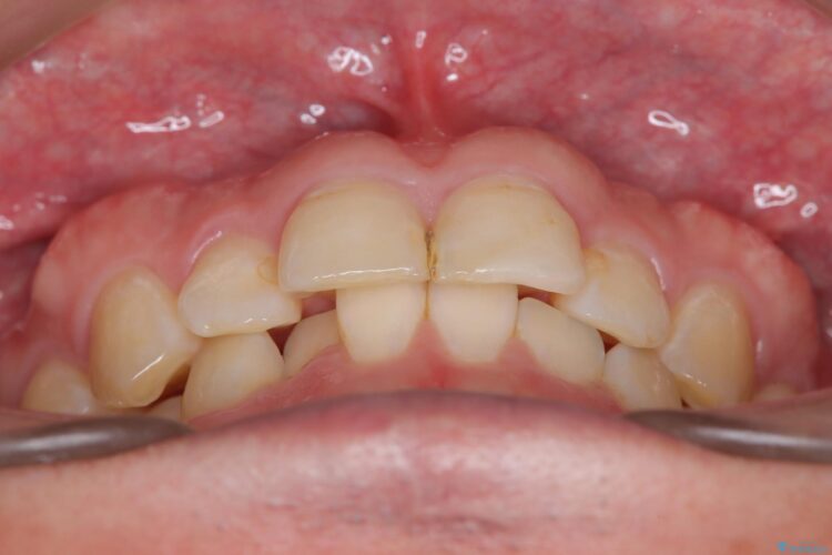 欠けた前歯をセラミッククラウンで補綴治療 治療途中画像
