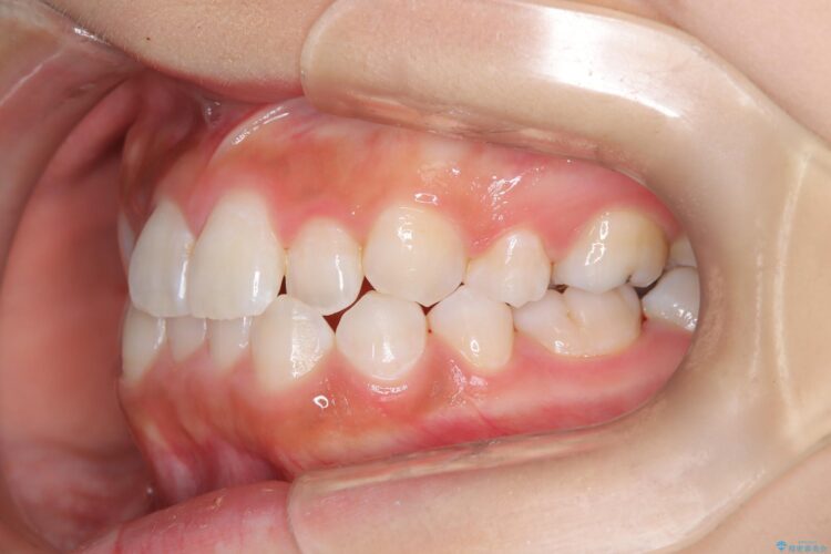 後戻りした交叉咬合（クロスバイト） マウスピースで再矯正 治療途中画像