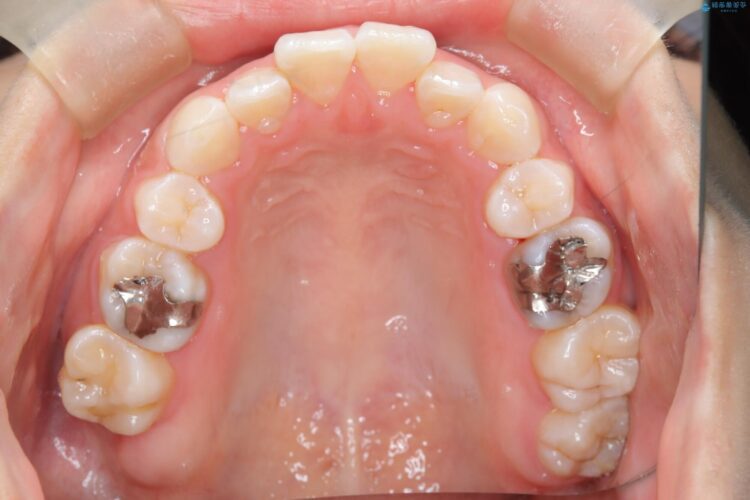 後戻りした交叉咬合（クロスバイト） マウスピースで再矯正 治療途中画像