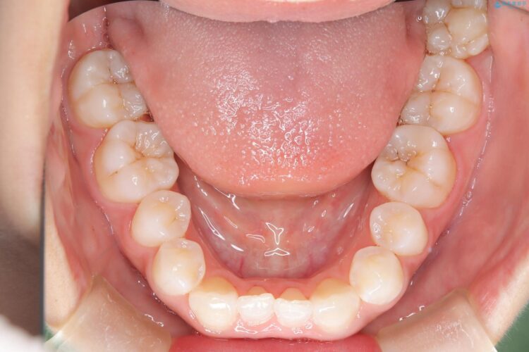 後戻りした交叉咬合（クロスバイト） マウスピースで再矯正 治療途中画像