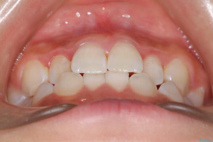 後戻りした交叉咬合（クロスバイト） マウスピースで再矯正 治療前画像