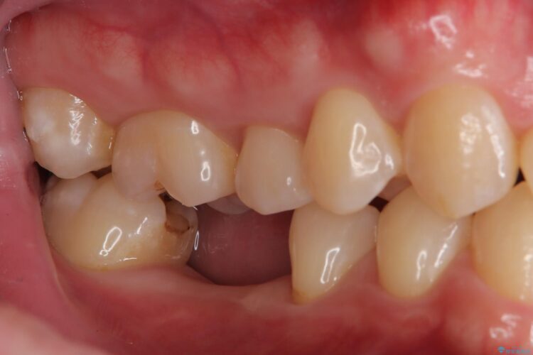 抜歯したまま放置していた部分へインプラント治療 治療前画像
