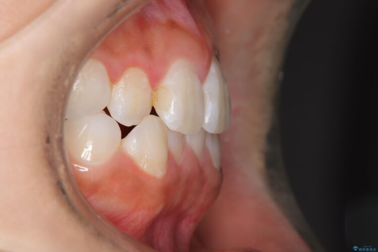 後戻りした交叉咬合（クロスバイト） マウスピースで再矯正 治療前画像