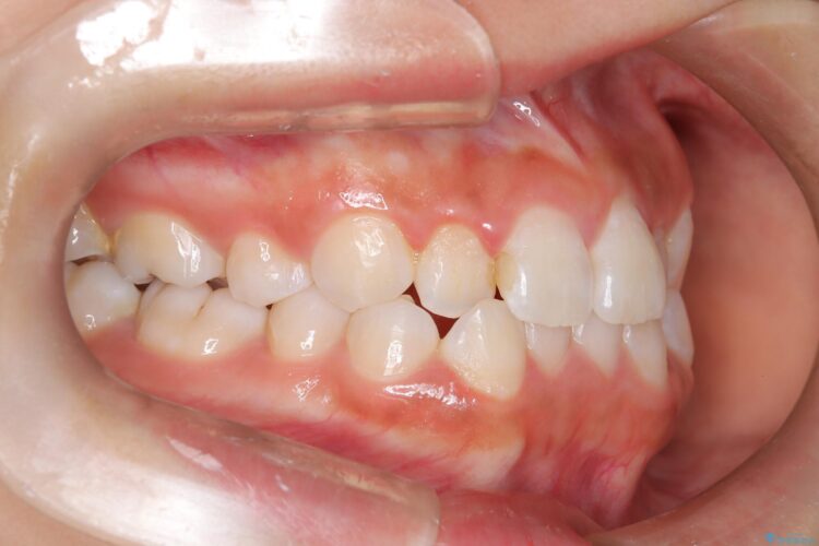 後戻りした交叉咬合（クロスバイト） マウスピースで再矯正 治療前画像