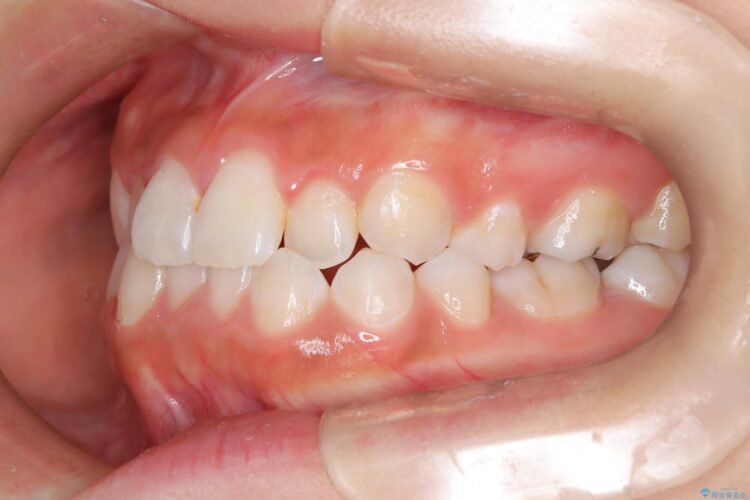 後戻りした交叉咬合（クロスバイト） マウスピースで再矯正 治療前画像
