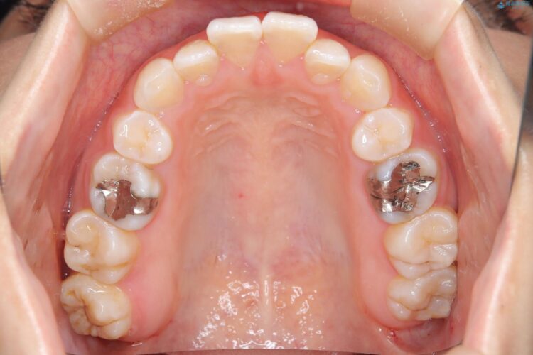 後戻りした交叉咬合（クロスバイト） マウスピースで再矯正 治療前画像