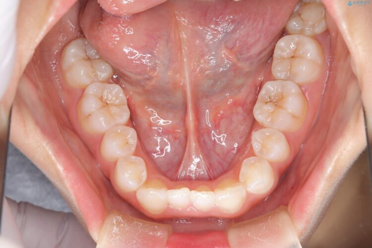 後戻りした交叉咬合（クロスバイト） マウスピースで再矯正 治療前画像