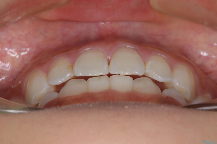 後戻りした交叉咬合（クロスバイト） マウスピースで再矯正 治療後画像