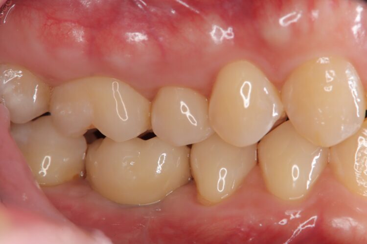 抜歯したまま放置していた部分へインプラント治療 治療後画像