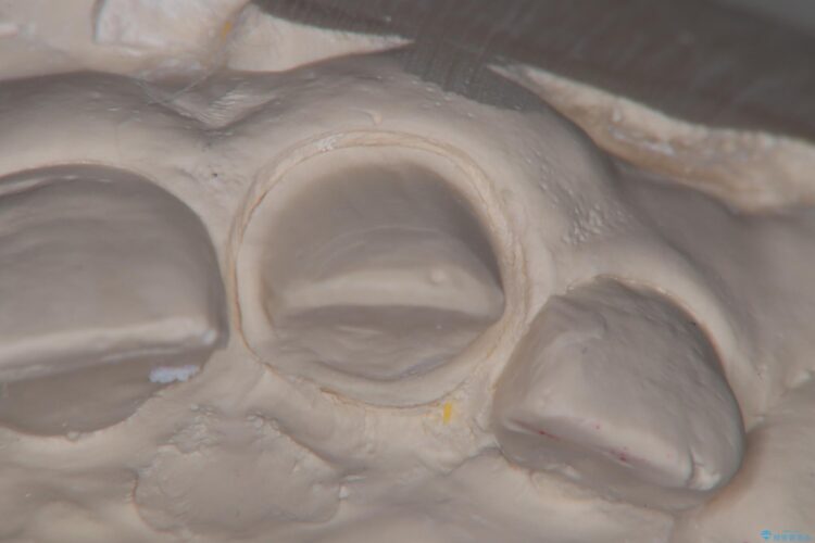 欠けた前歯をセラミッククラウンで補綴治療 治療後画像