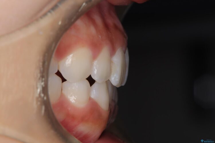 後戻りした交叉咬合（クロスバイト） マウスピースで再矯正 治療後画像