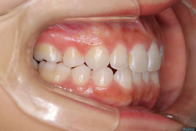 後戻りした交叉咬合（クロスバイト） マウスピースで再矯正 治療後画像