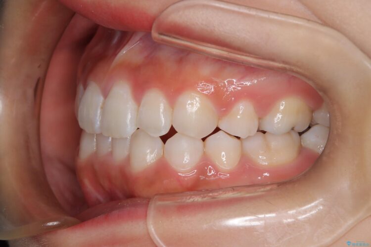 後戻りした交叉咬合（クロスバイト） マウスピースで再矯正 治療後画像