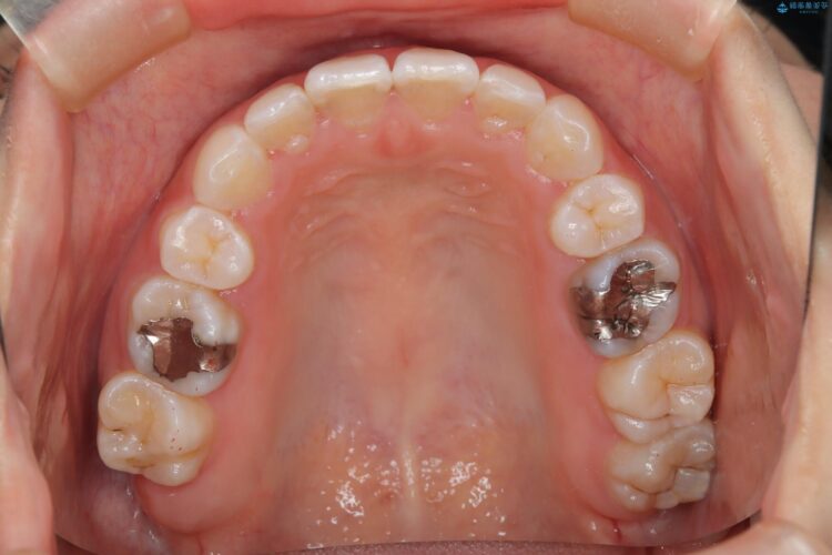 後戻りした交叉咬合（クロスバイト） マウスピースで再矯正 治療後画像