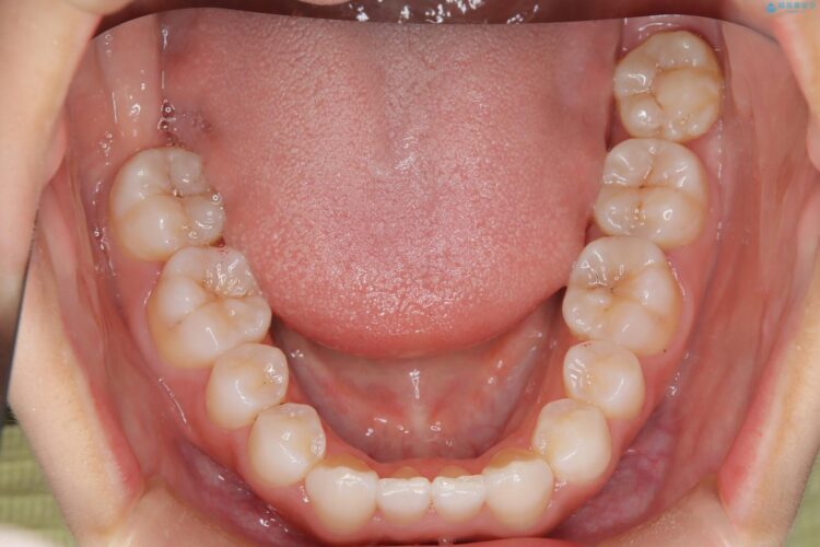 後戻りした交叉咬合（クロスバイト） マウスピースで再矯正 治療後画像