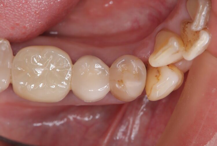 フロスがちぎれて取れない　他院で治療した歯の凹みを改善 治療前画像